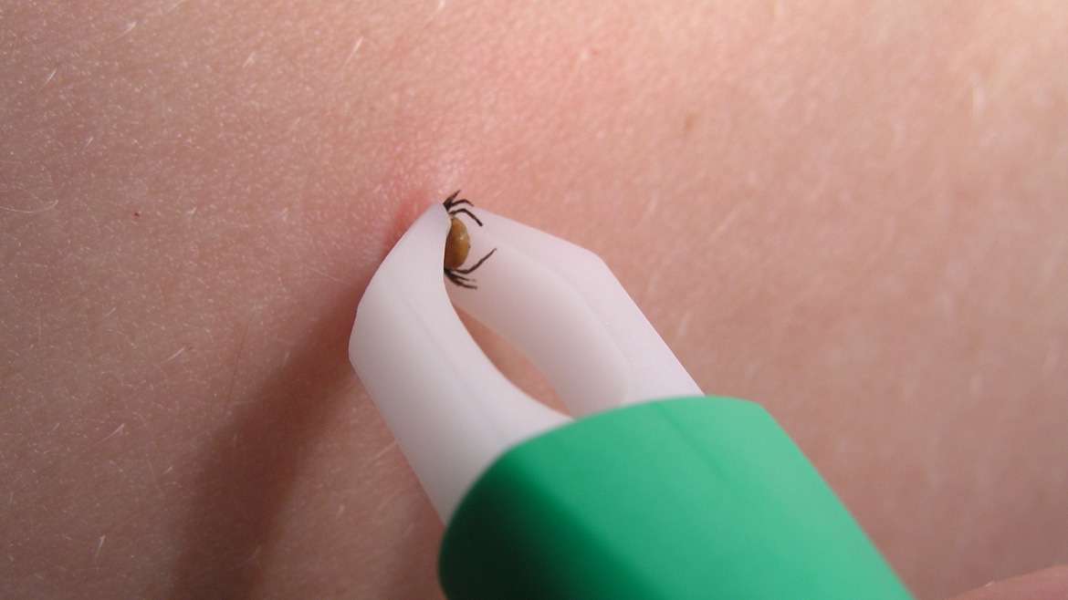 Statcare Removes Ticks